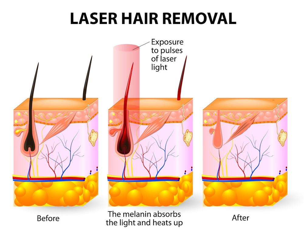 laser hair removal follicile removal before and after preview. 