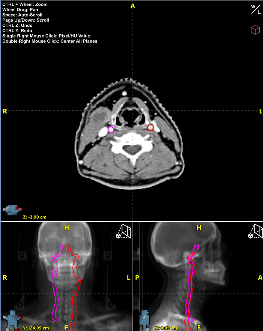 Radformation AutoContour Carotid Artery