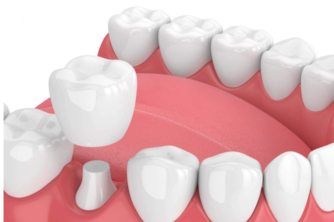 Bọc răng sứ là gì? Giải đáp chi tiết, quy trình, chi phí và những lưu ý quan trọng