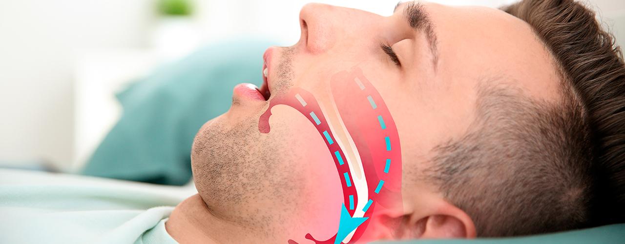 Tipos de apneia do sonoSaiba quais são os tipos de apneia do sono - Biologix