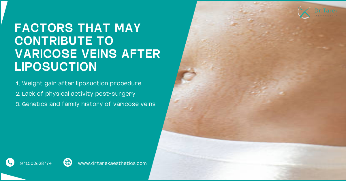 Can Liposuction Cause Varicose Veins