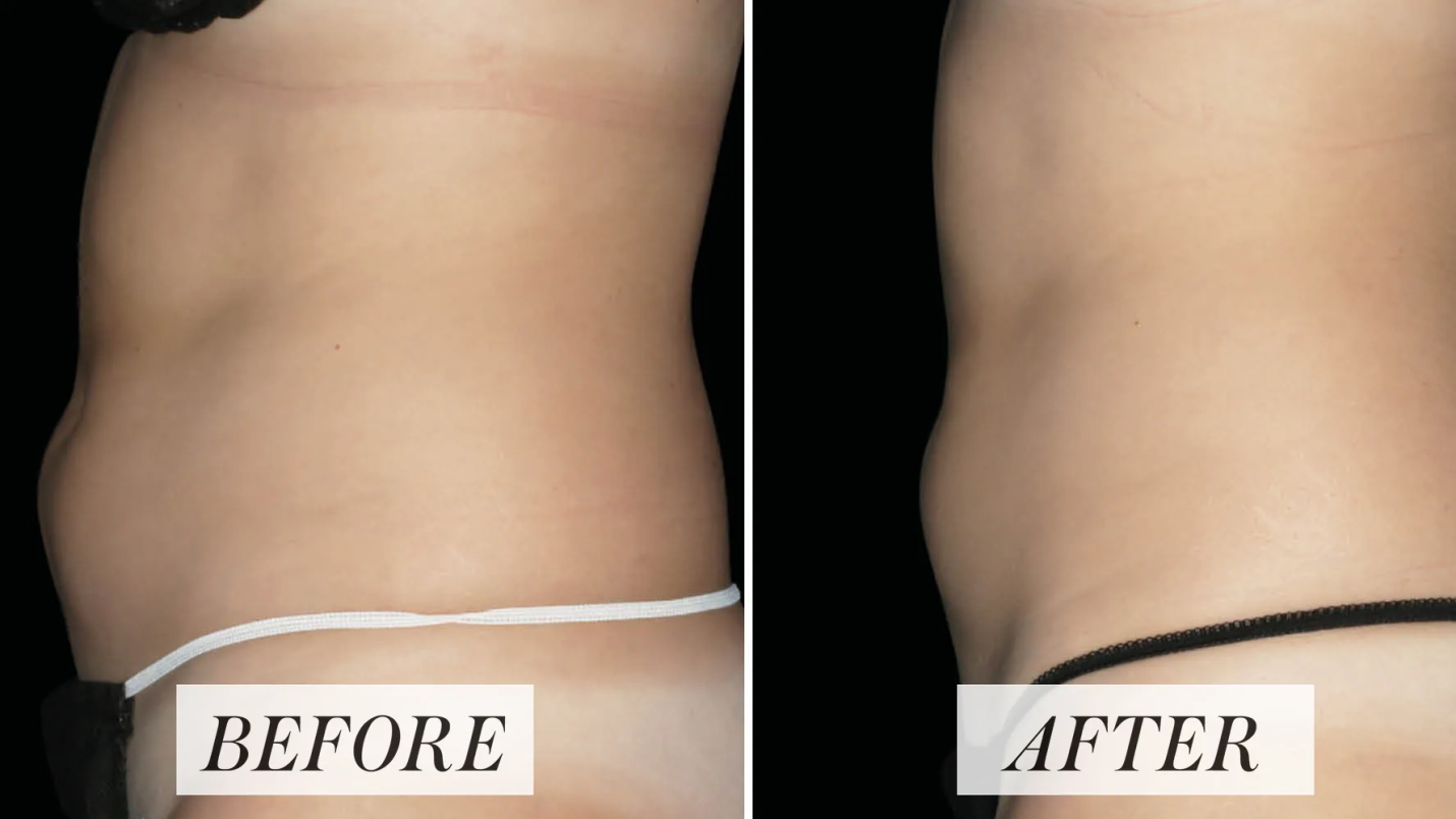 A Guide to Your First Emsculpt Treatment