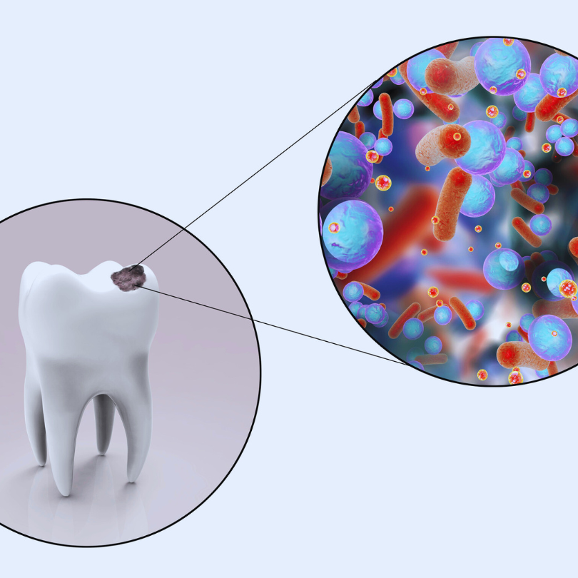Define Cavity: A Comprehensive Guide for Boston Residents