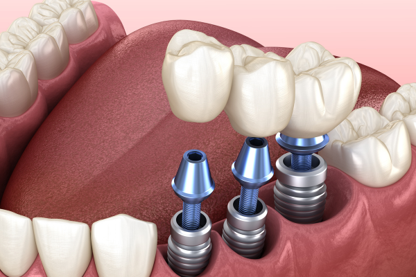 Trồng răng Implant ghép xương: Tất tần tật điều bạn cần biết