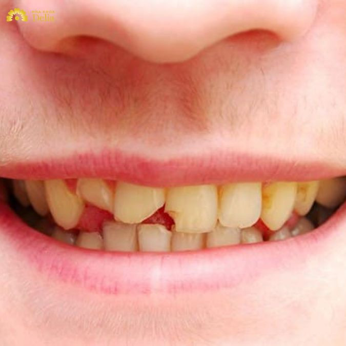Răng mẻ vỡ không chỉ ảnh hưởng đến tính thẩm mỹ của hàm răng mà còn khiến bạn mất tự tin trong giao tiếp