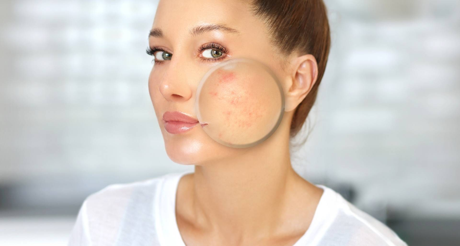 in this image the girl is having acne scars which are highlighted by 
 https://renewyou.co.in/