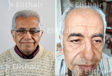 زراعة الشعر للسيد عاطف - مركز اليت هير