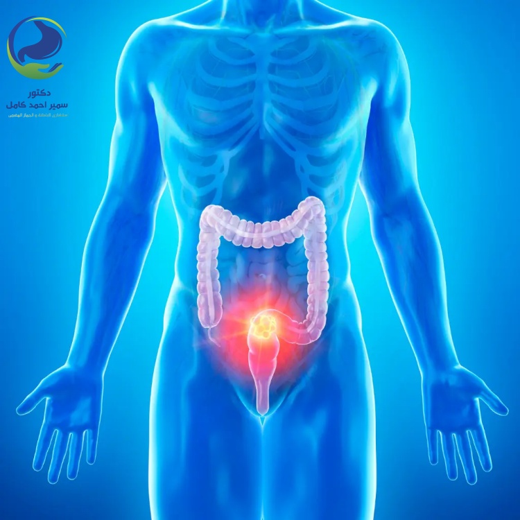 كيفية الوقاية من امراض القولون
