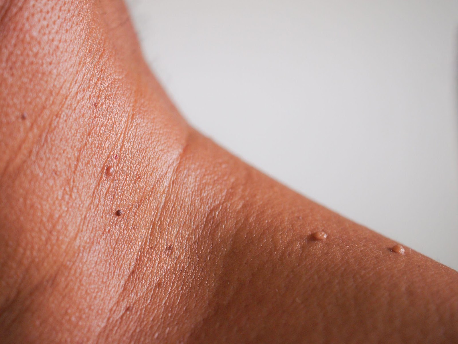 Skin tags Singapore