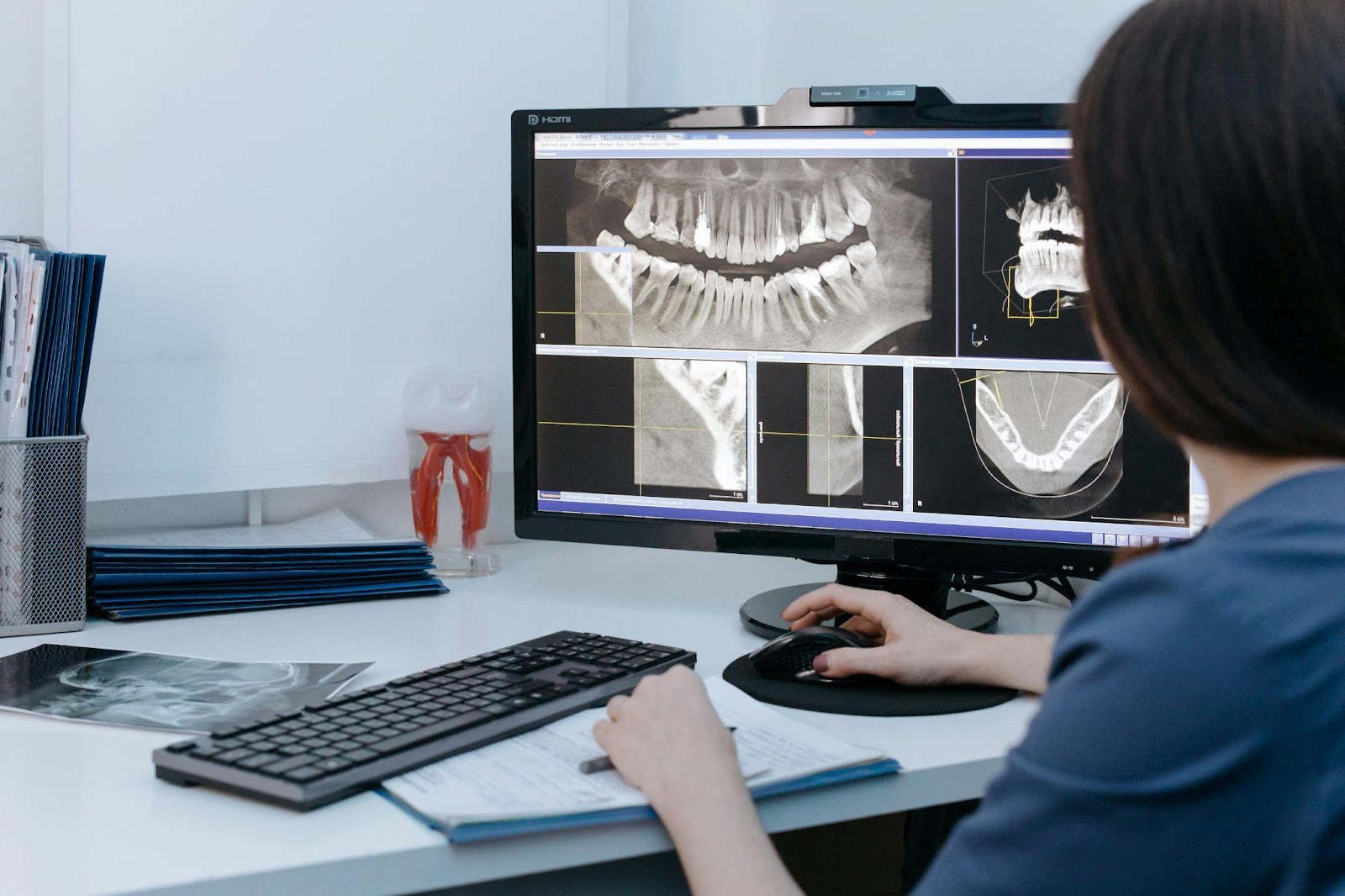Bone Loss with Dental Implants