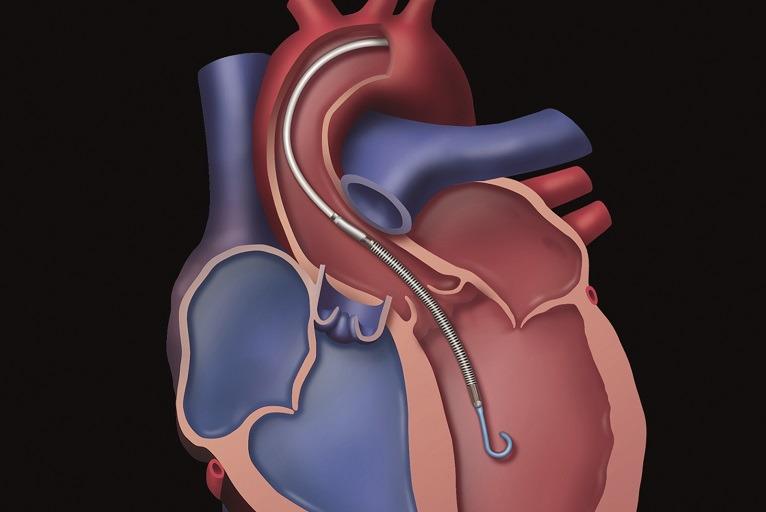 Abiomed Impella Heart Pump Device 