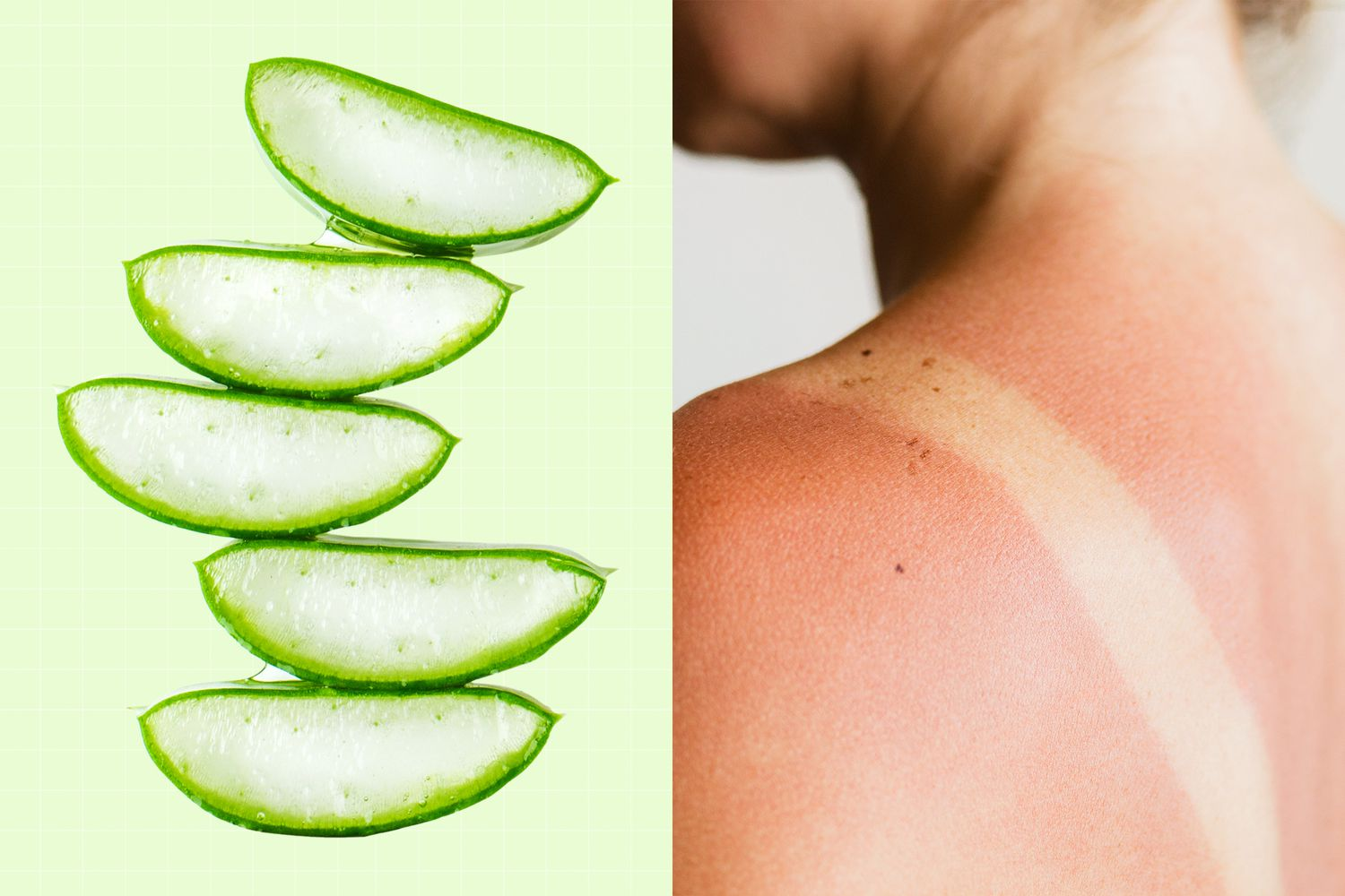     aloevera for sunburn