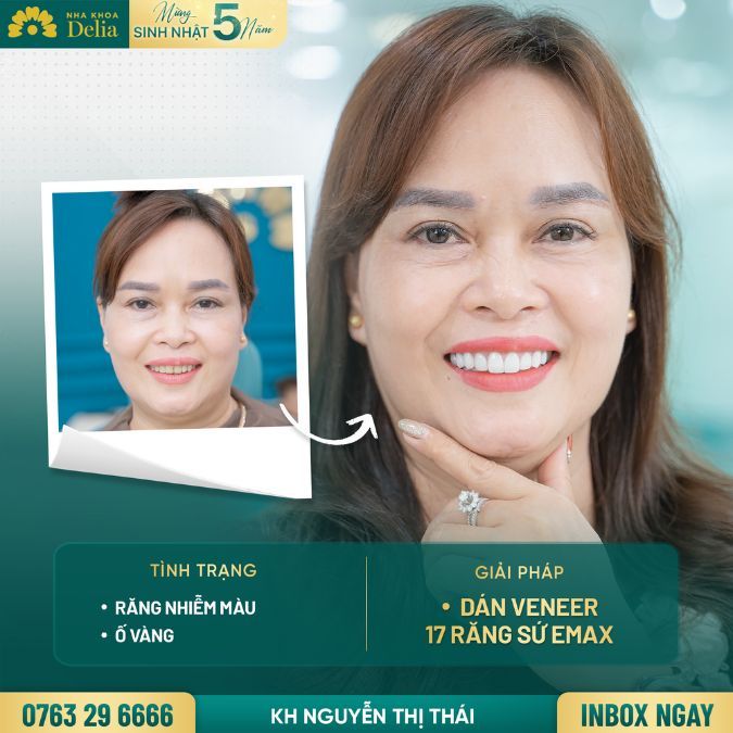 Mặt dán sứ Veneer Emax