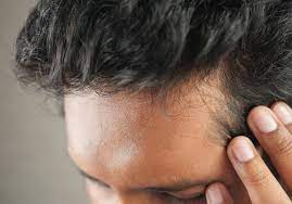 Hair Loss Treatment Ireland | Lloyds Online Doctor IE