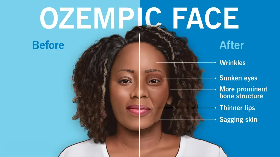 Face Image Before and After Ozempic Injections