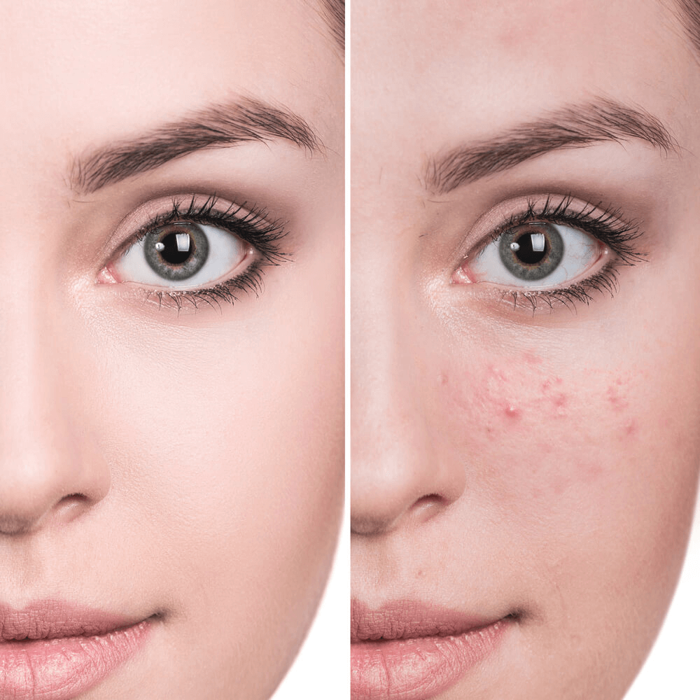 AI Skin Retouch: Remove Pimples with Our Photo Editor App — Photo №4
