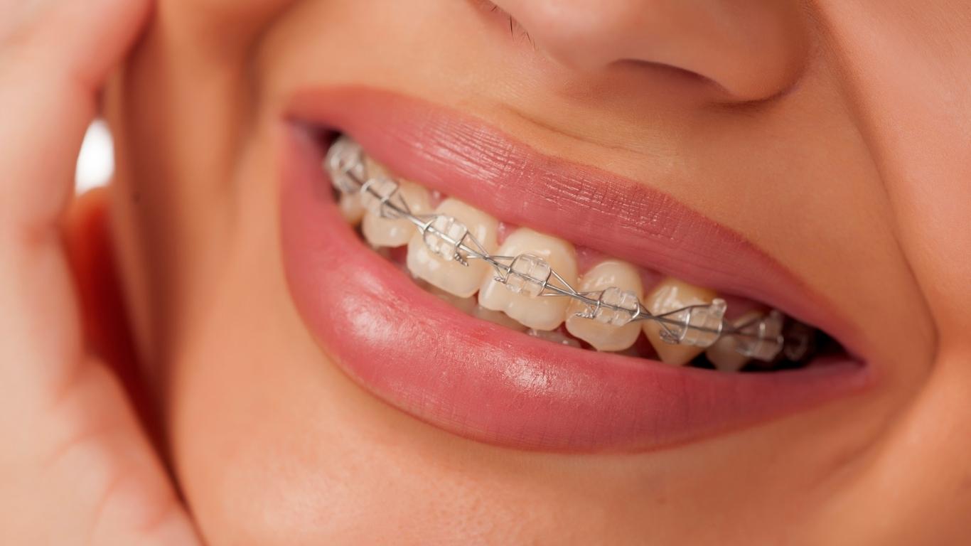 Ceramic Braces