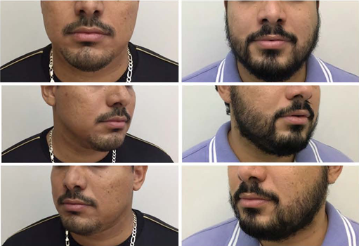 transplante de barba