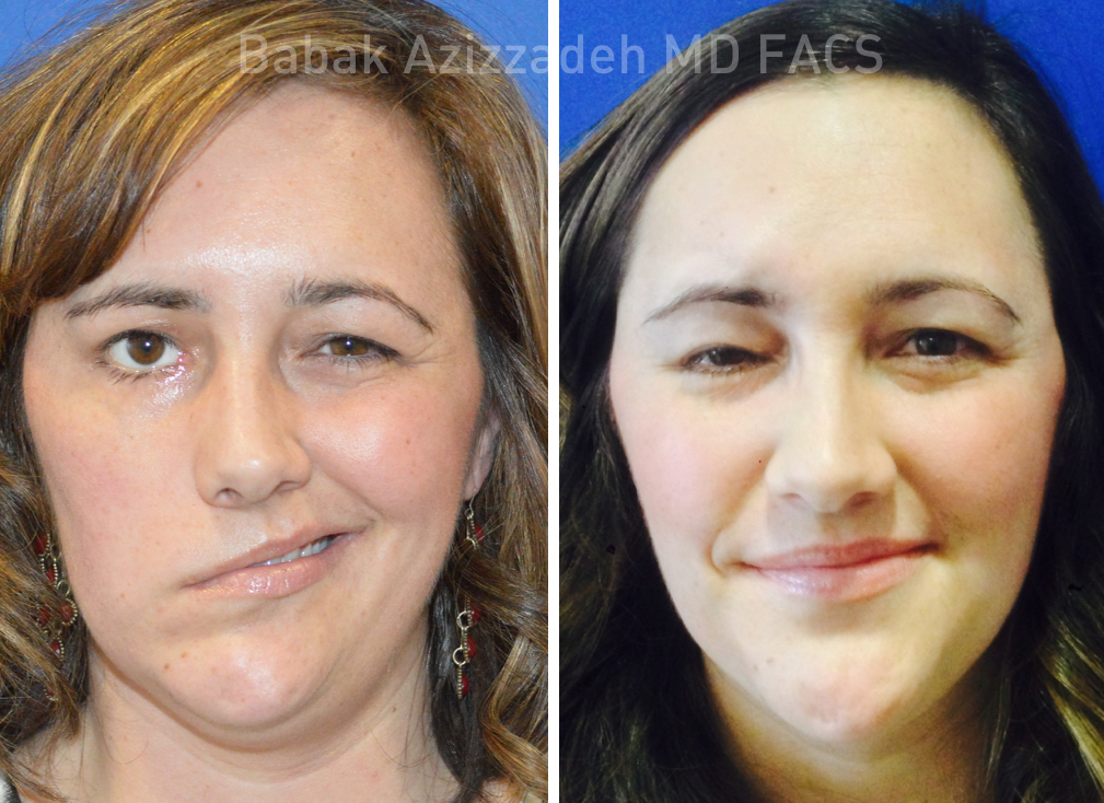 Masseter to Trigeminal Facial Nerve Transfer 