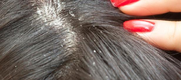 dandruff, seborrheic keratosis, seborrheic dermatitis