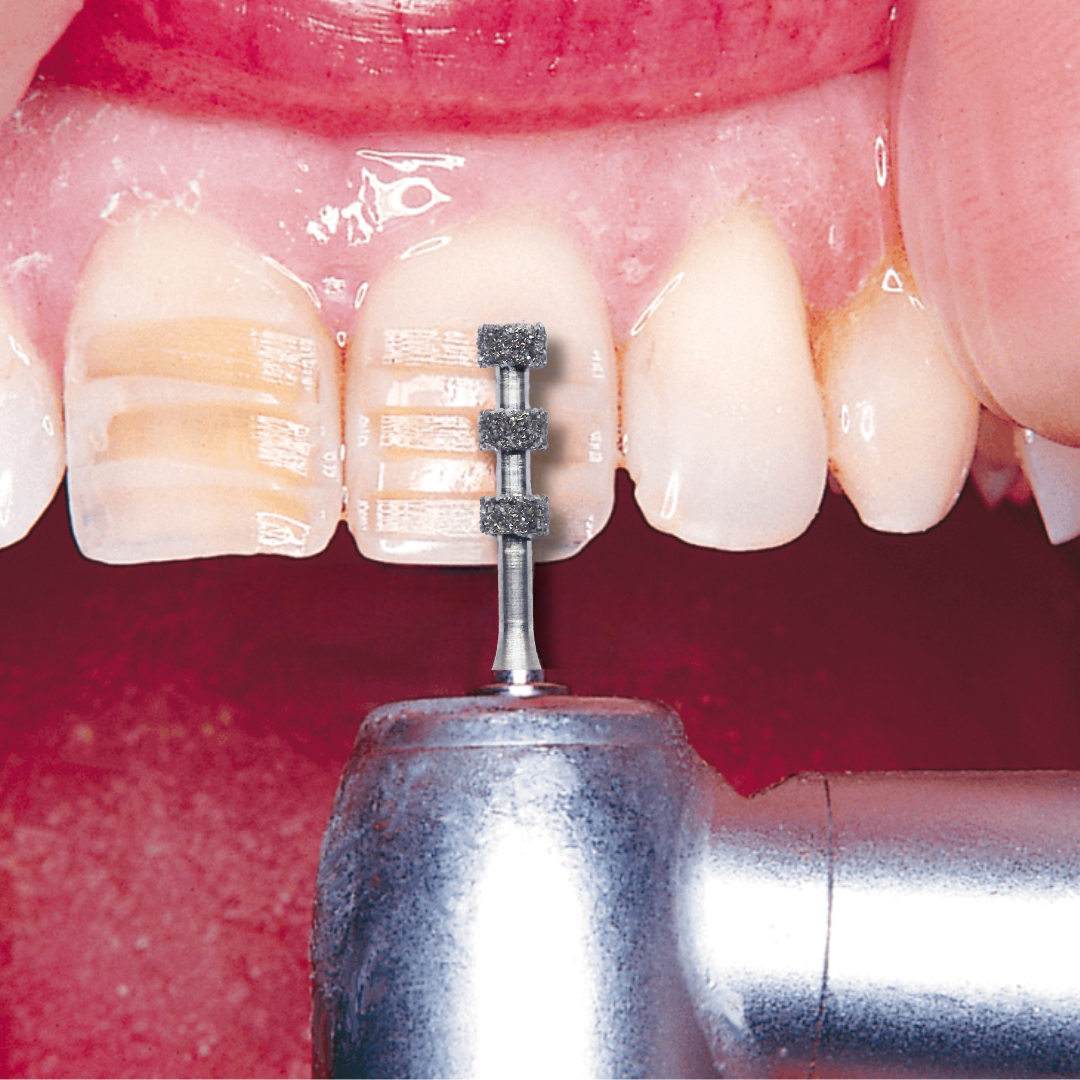 Mr. Bur Depth Marker Bur used for aesthetic excellence with ultra-thin porcelain veneers, ensuring precise enamel reduction and natural-looking restorative outcomes.