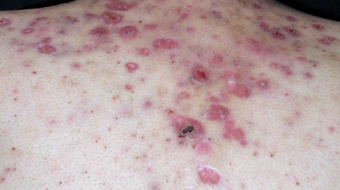 nodular acne