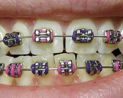 Image of Braces