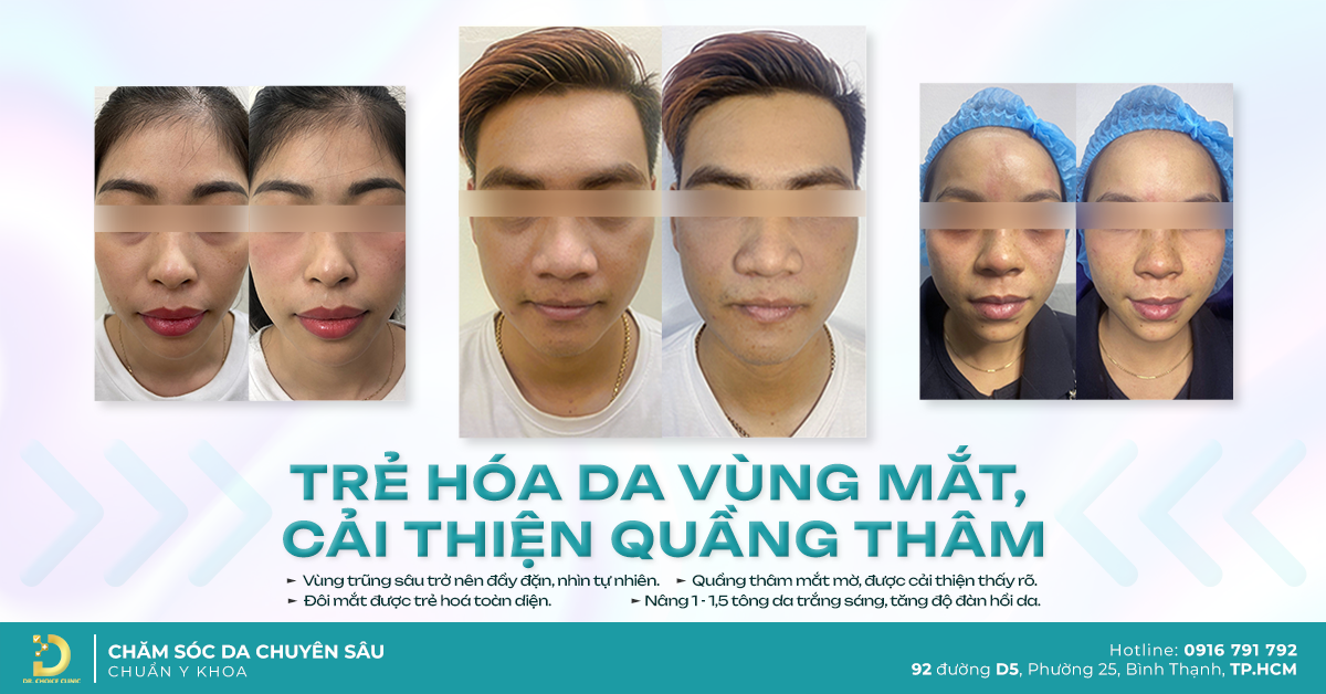 Kết quả điều trị quầng thâm mắt Dr Choice Clinic