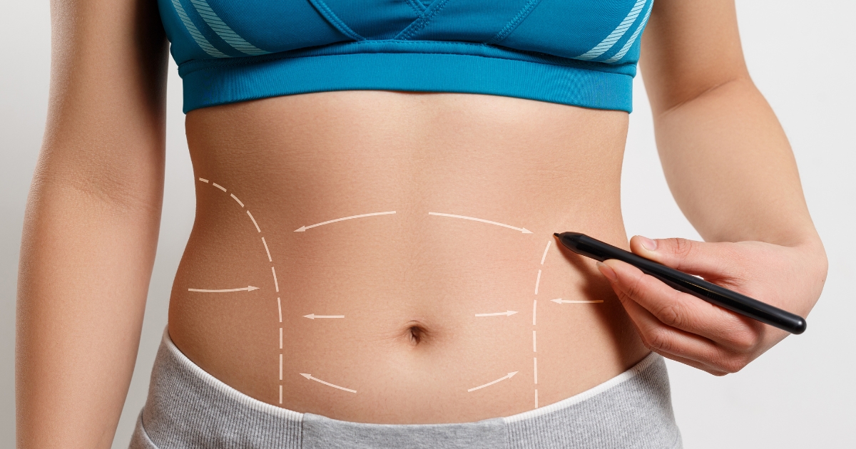 Will Liposuction Get Rid Of Belly Fat