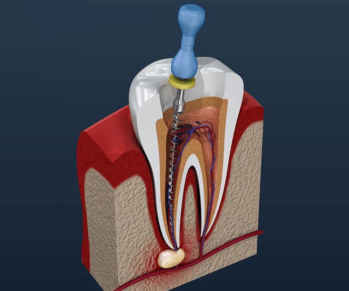 Root Canal Treatment