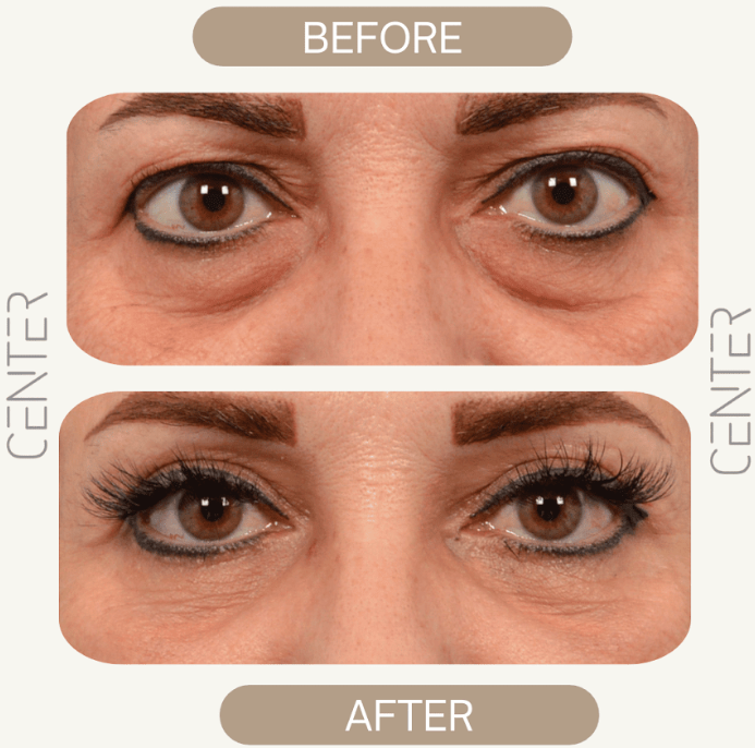 Under-eye bags removed, eyes refreshed