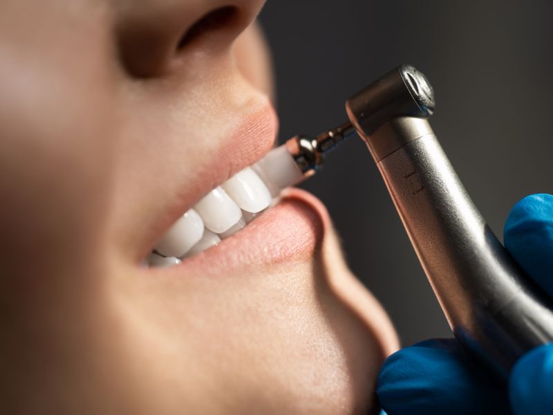 quanto custa limpeza dental técnicas utilizadas