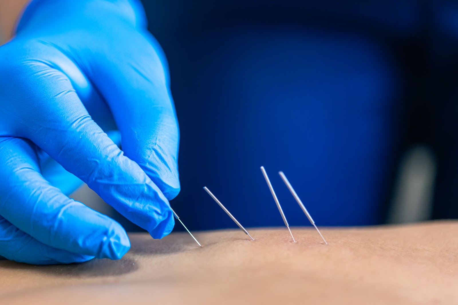 Person in gloves administering acupuncture needles. 