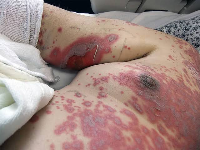 Is septrin banned in Nigeria as claimed in viral audio?