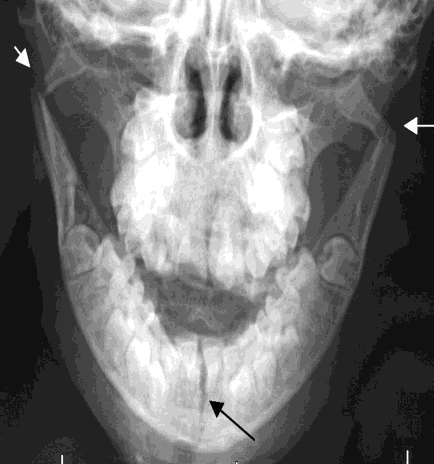 Résultat de recherche d'images pour "fracture mandibulaire  sur mordu occlusale"