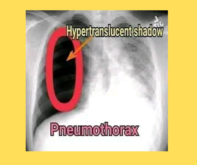 What is Pneumothorax?