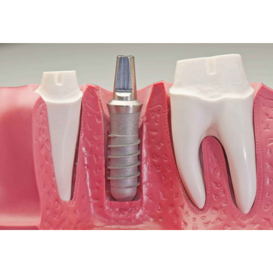 Root Canal or Implant – Which One Lasts Longer?