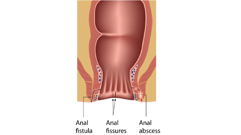 آبسه و فیستول مقعدی