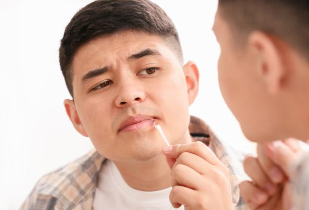man cold sores