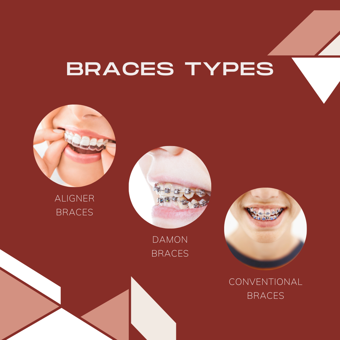 Discover how much do braces cost