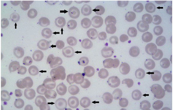 hemoglobinopatia C