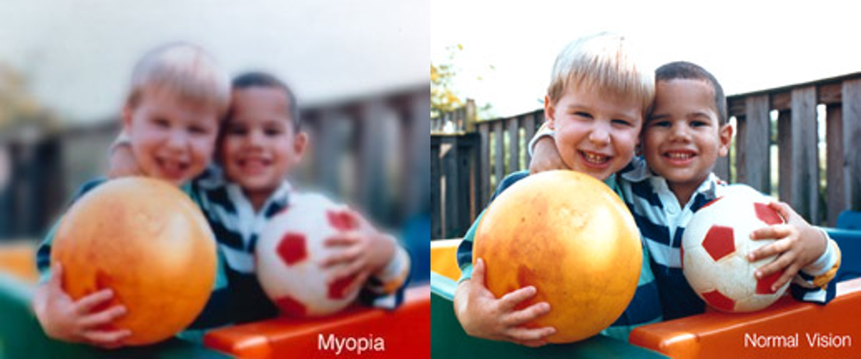 myopia vision vs normal vision