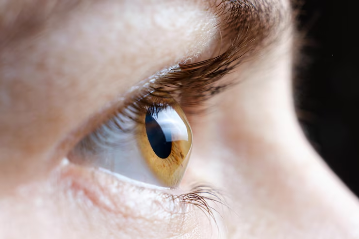 Experiencing Blurry Vision in Reseda? It Could Be Keratoconus