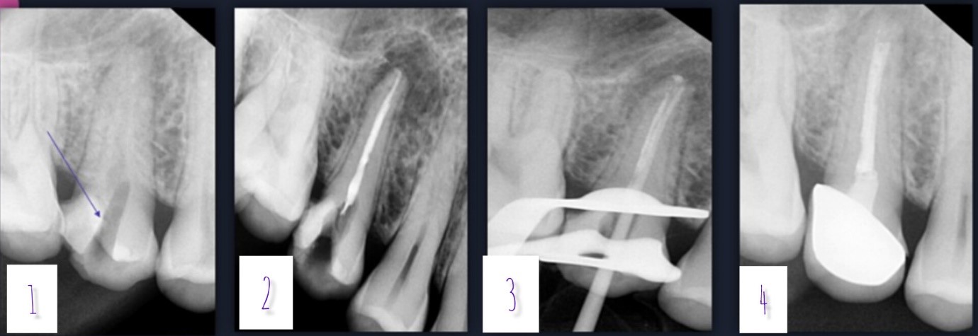 X-ray of a bone
Description automatically generated