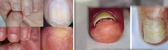 C:\Users\Administrator\Desktop\articles pics\health4992\19-01-2025\iron for human body\brittle nails.jpg