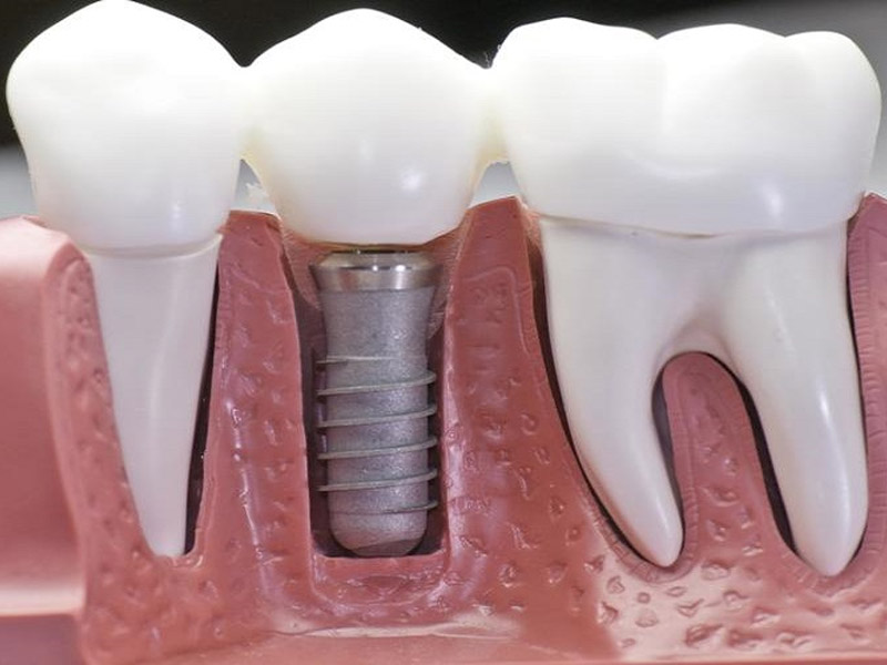 Chi phí trồng răng sứ Implant vĩnh viễn có giá khá đắt