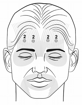 Botox Training Frontalis Injection Pattern