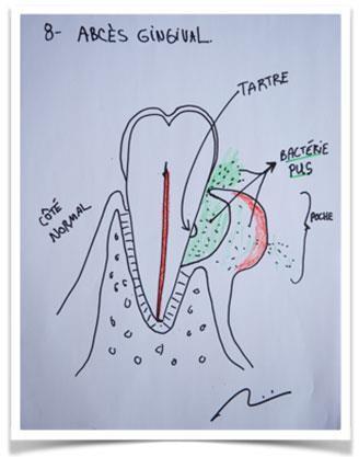 abces-gingival-dentaire-dr-villemaire-sherbrooke.jpg