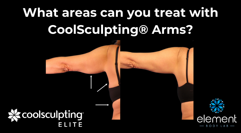 what areas can you treat with coolsculpting arms visual