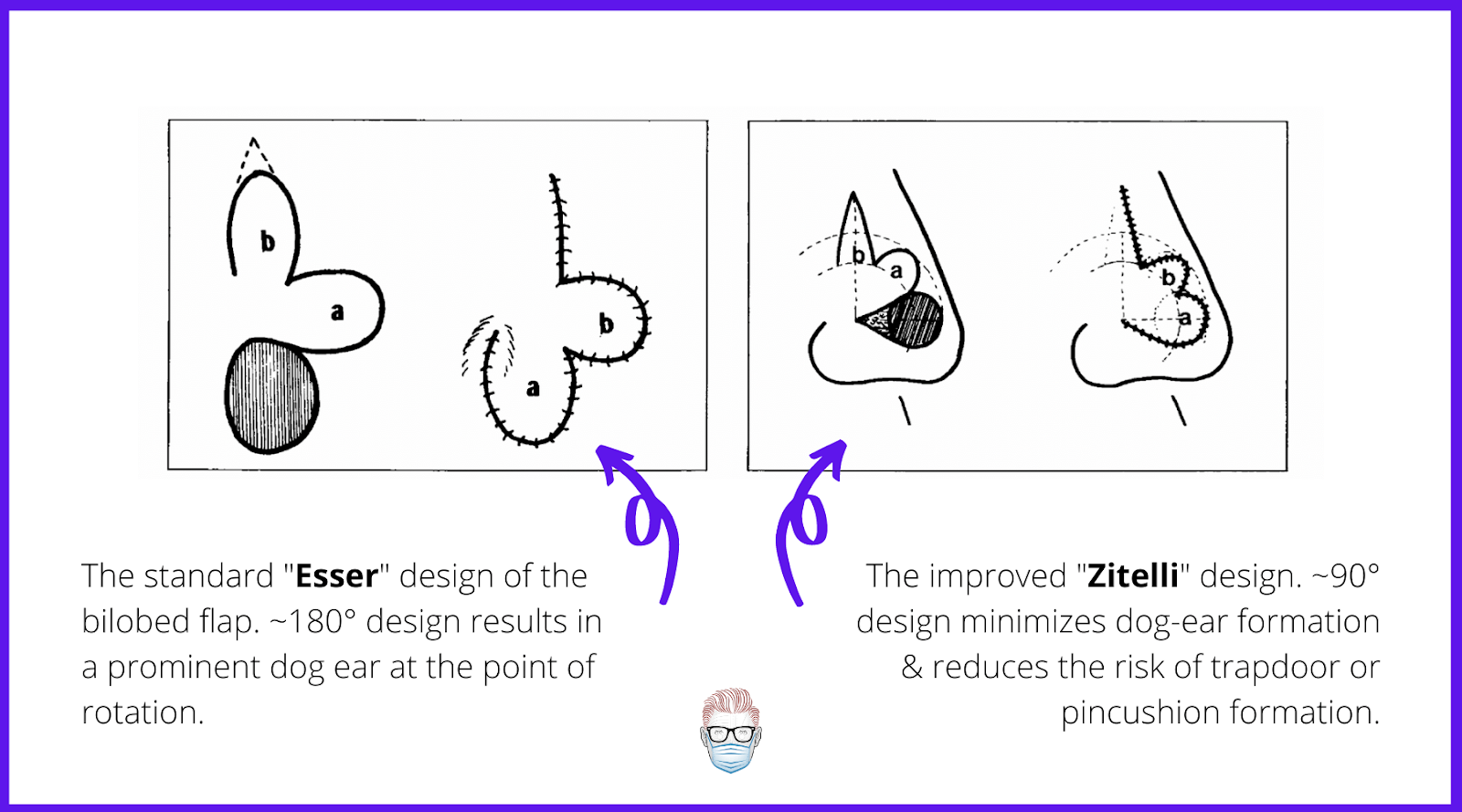 Comparision of the Esser (Left) and Zitelli (Right) Bilobed Flap Designs